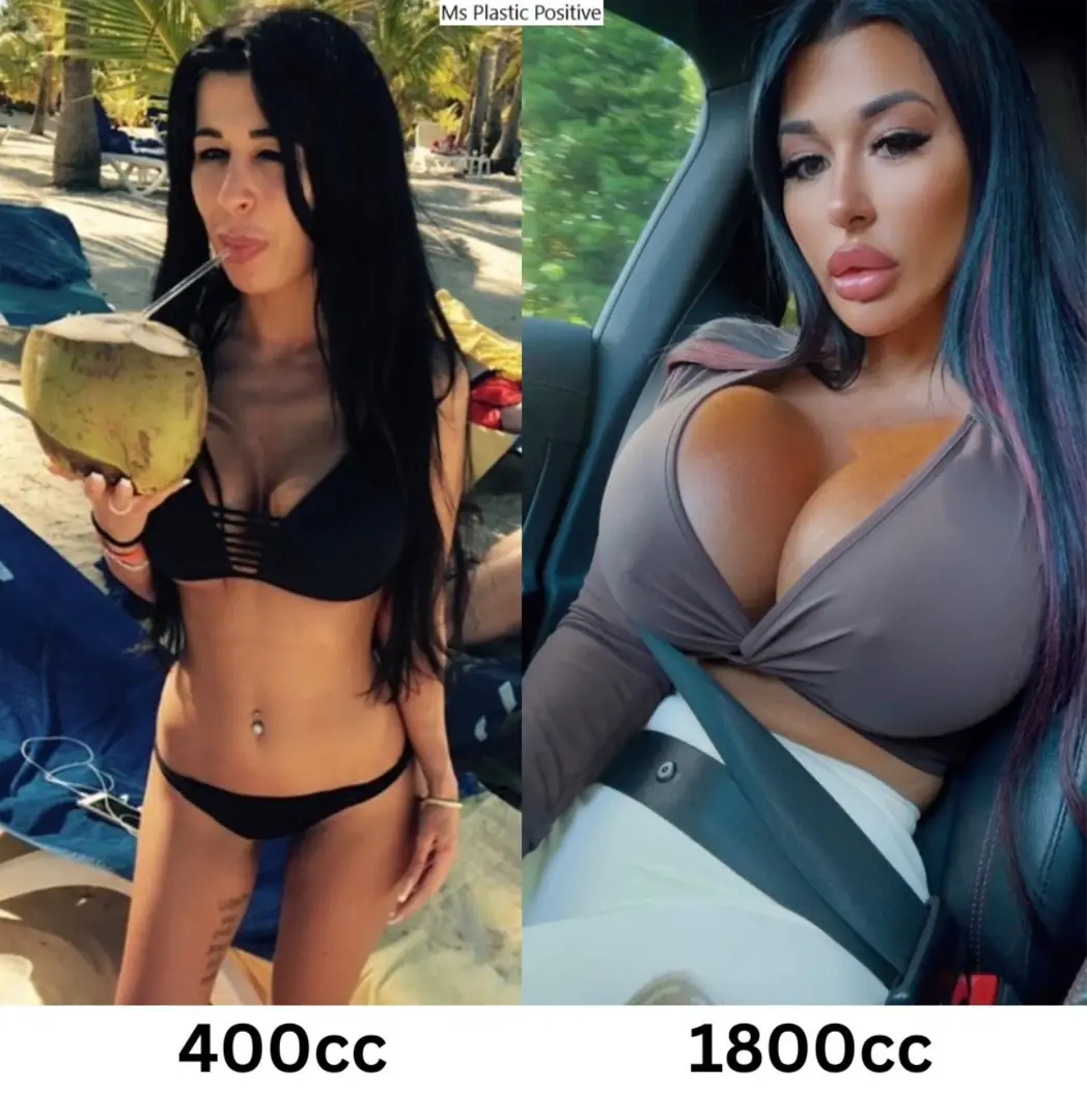 My Brutal Plastic Bimbo Transformation: Why 1800cc Isn’t Enough and 2600cc is Next