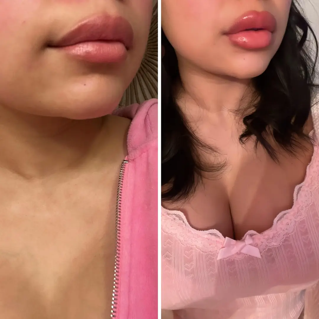 Plumped lips and heart shaped nipple tattoos for the ultimate bimbo upgrade