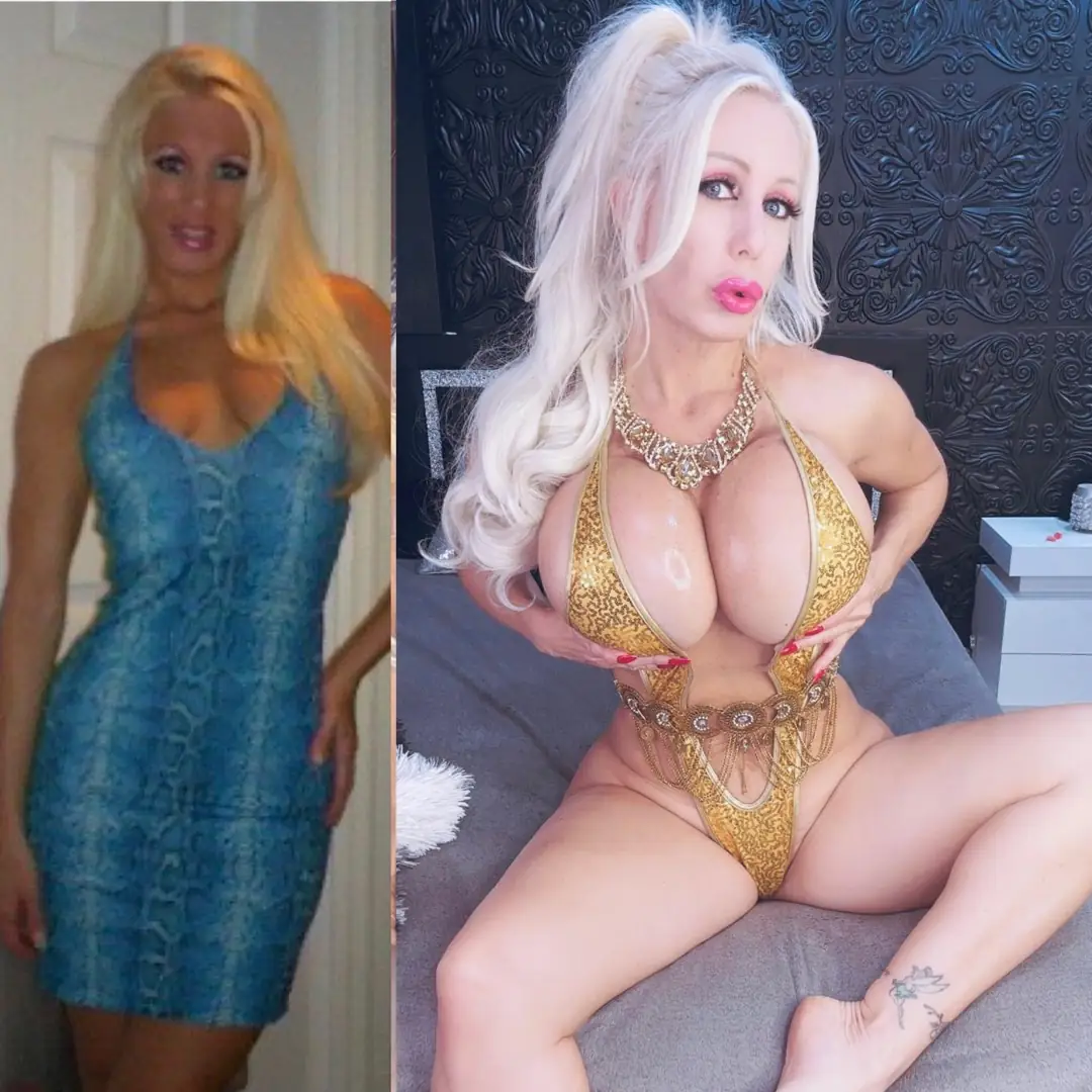 Satisfying my boob greed and upgrading these 1500cc tits to 2500cc giant bimbo jugs